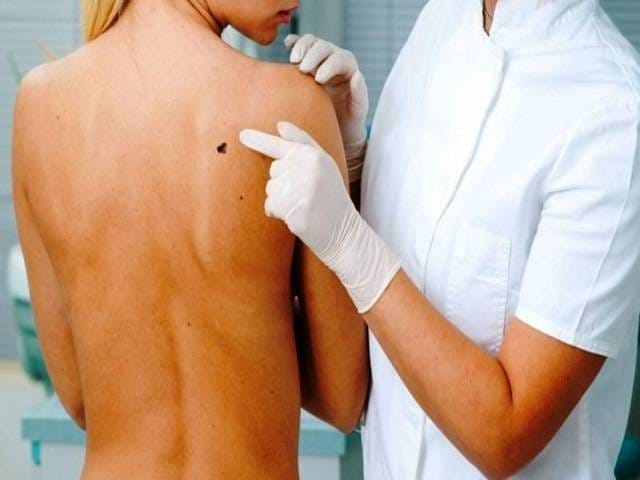 Ladispoli, prevenzione del melanoma: continua l’impegno a 360 gradi di Monica Forchetta e Apaim