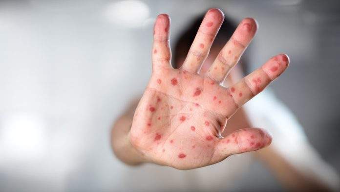 Aumento dei casi di morbillo nel Lazio, al via campagna social della Asl Roma 3