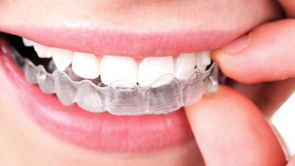 apparecchio ortodontico invisibile 1