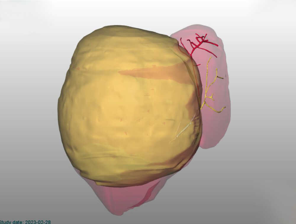IMMAGINE 3D DELLA MASSA TUMORALE NEL FEGATO PRIMA DELL'INTERVENTO