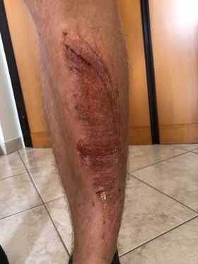 caduta fibra ottica escoriazioni (1)