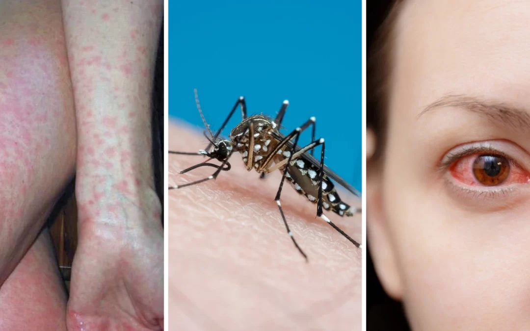 Approvato un nuovo vaccino, è quello contro la malattia da Dengue