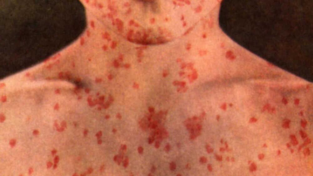 morbillo-2-1280×720 morbillo-2-1280x720