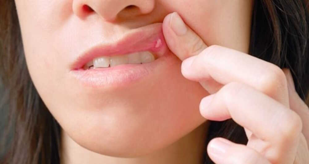 afte in bocca afte in bocca