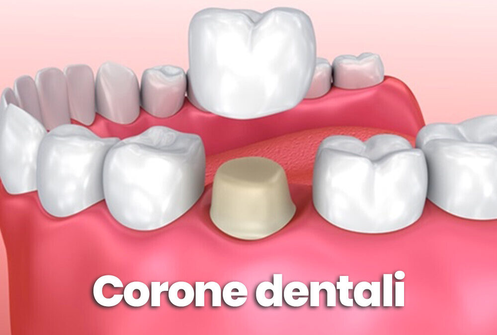 Corone dentali: cosa sono e quando farsene una